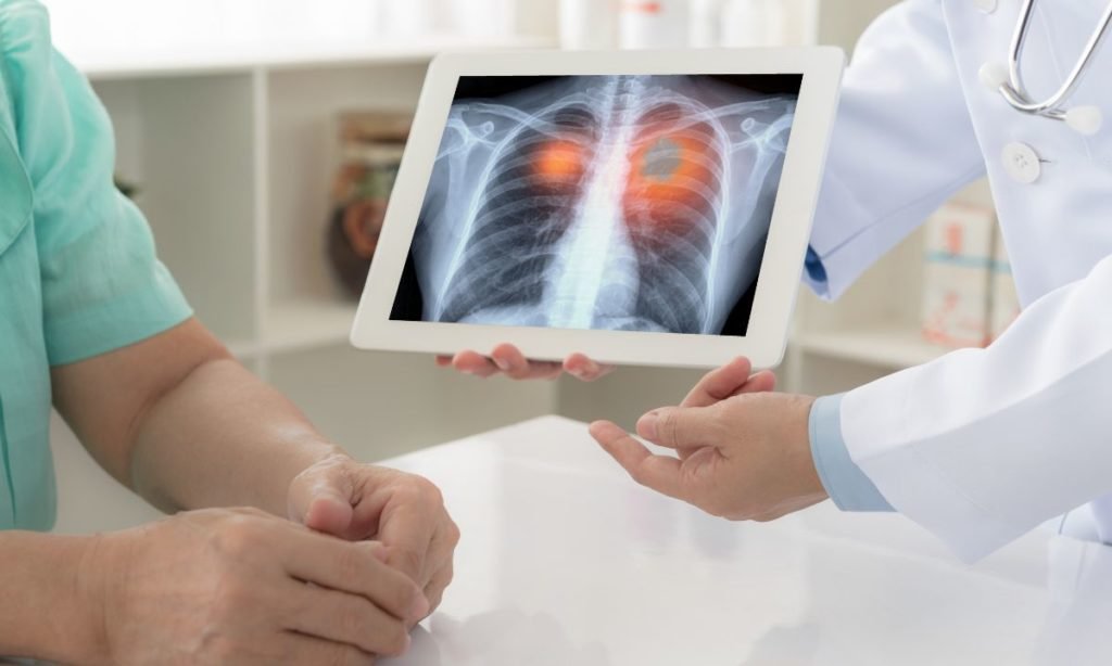 cáncer de pulmón