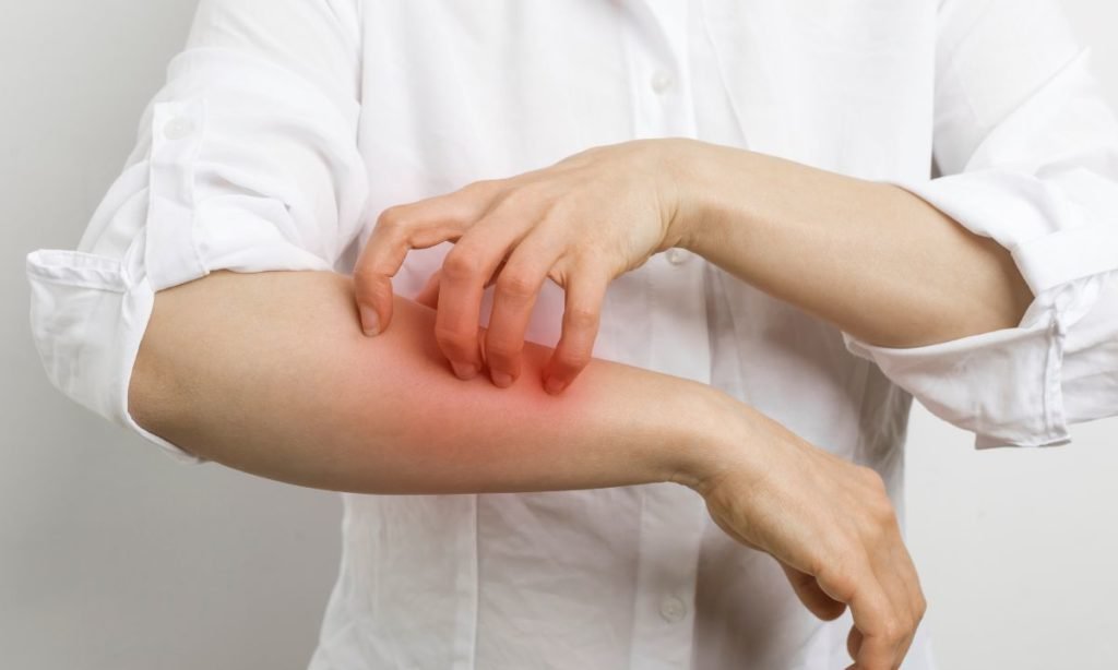 dermatitis atópica